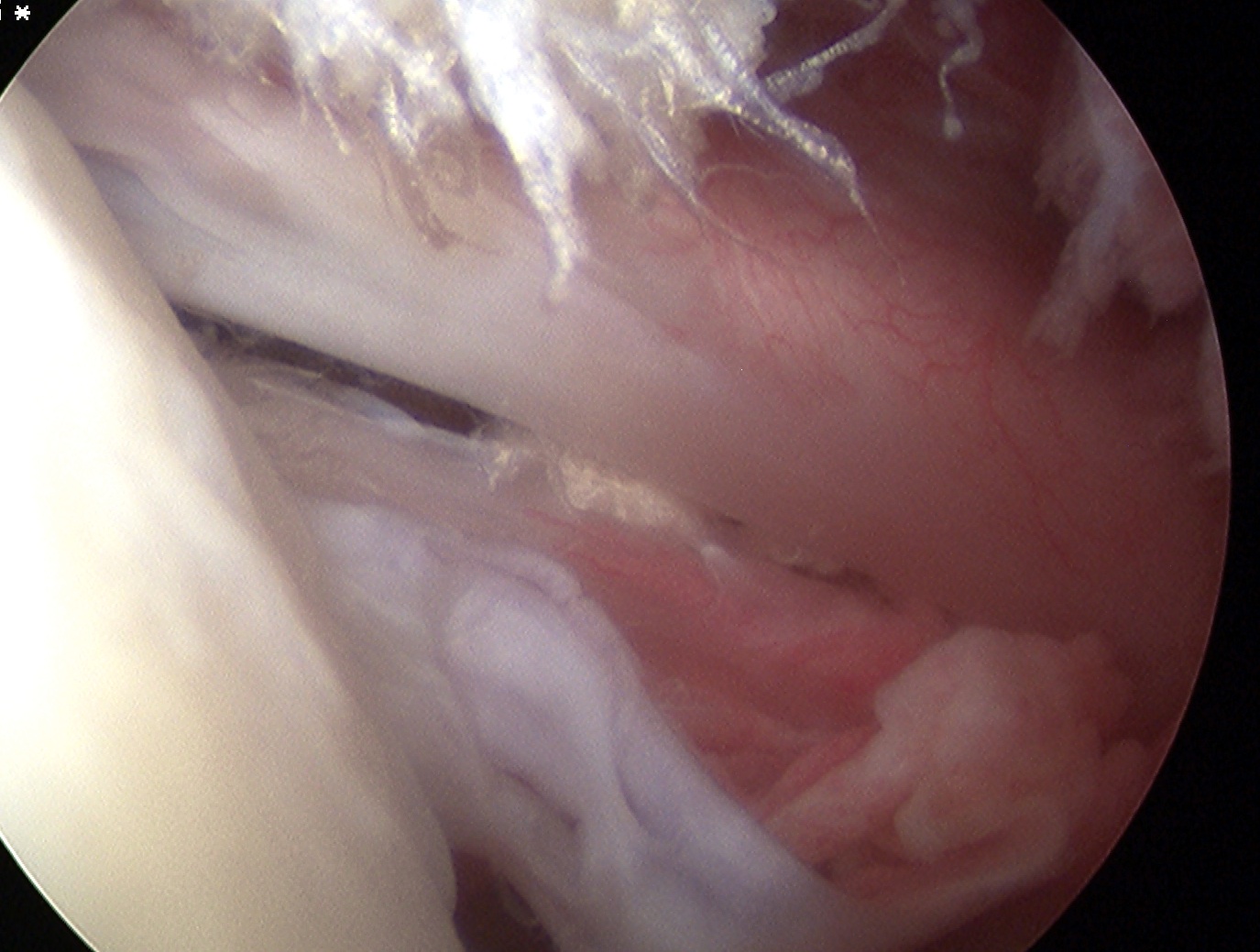 SSC Longitudinal Tear